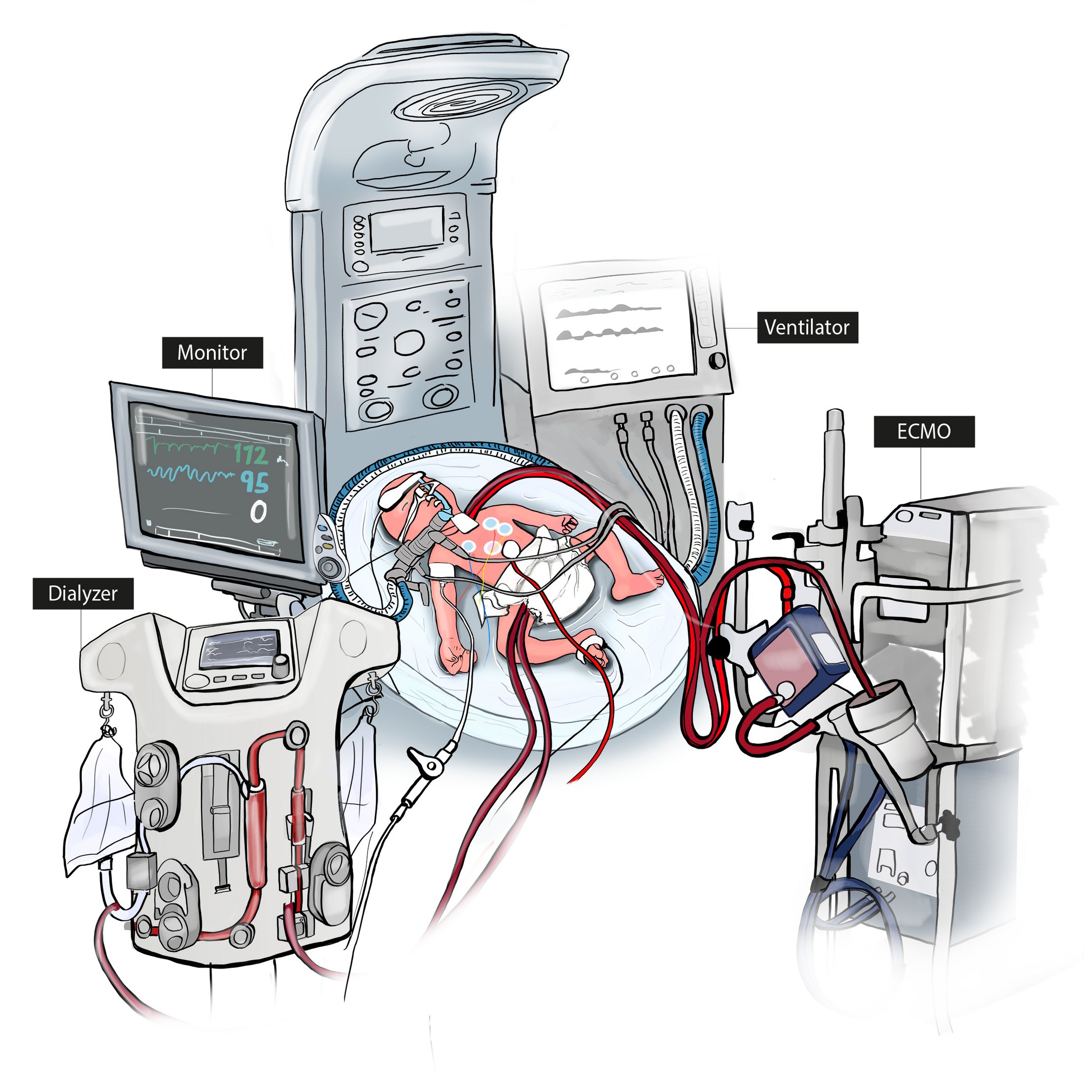 Newborn connected to ECMO, ventilator, monitor, and dialysis machine in NICU setting.