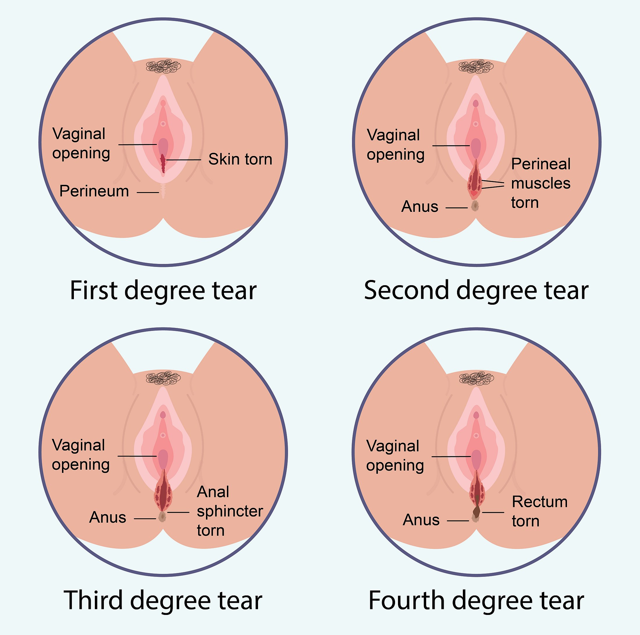 Degrees of perineal tearing during childbirth Medical infographic comparing first-, second-, third-, and fourth-degree perineal tears.