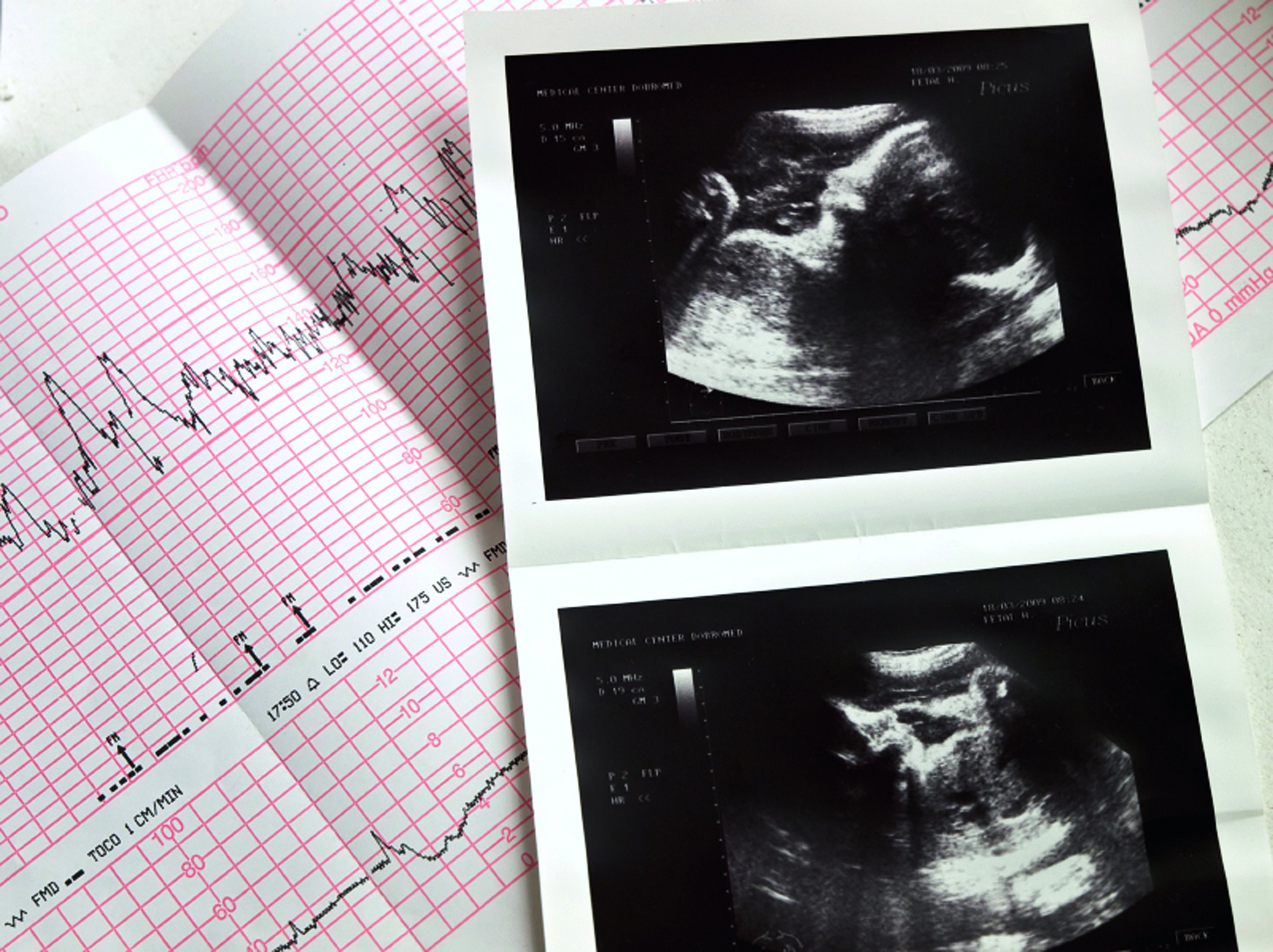 Ultrasound images and fetal monitoring during pregnancy Printed ultrasound images lying beside fetal heart rate monitoring records.