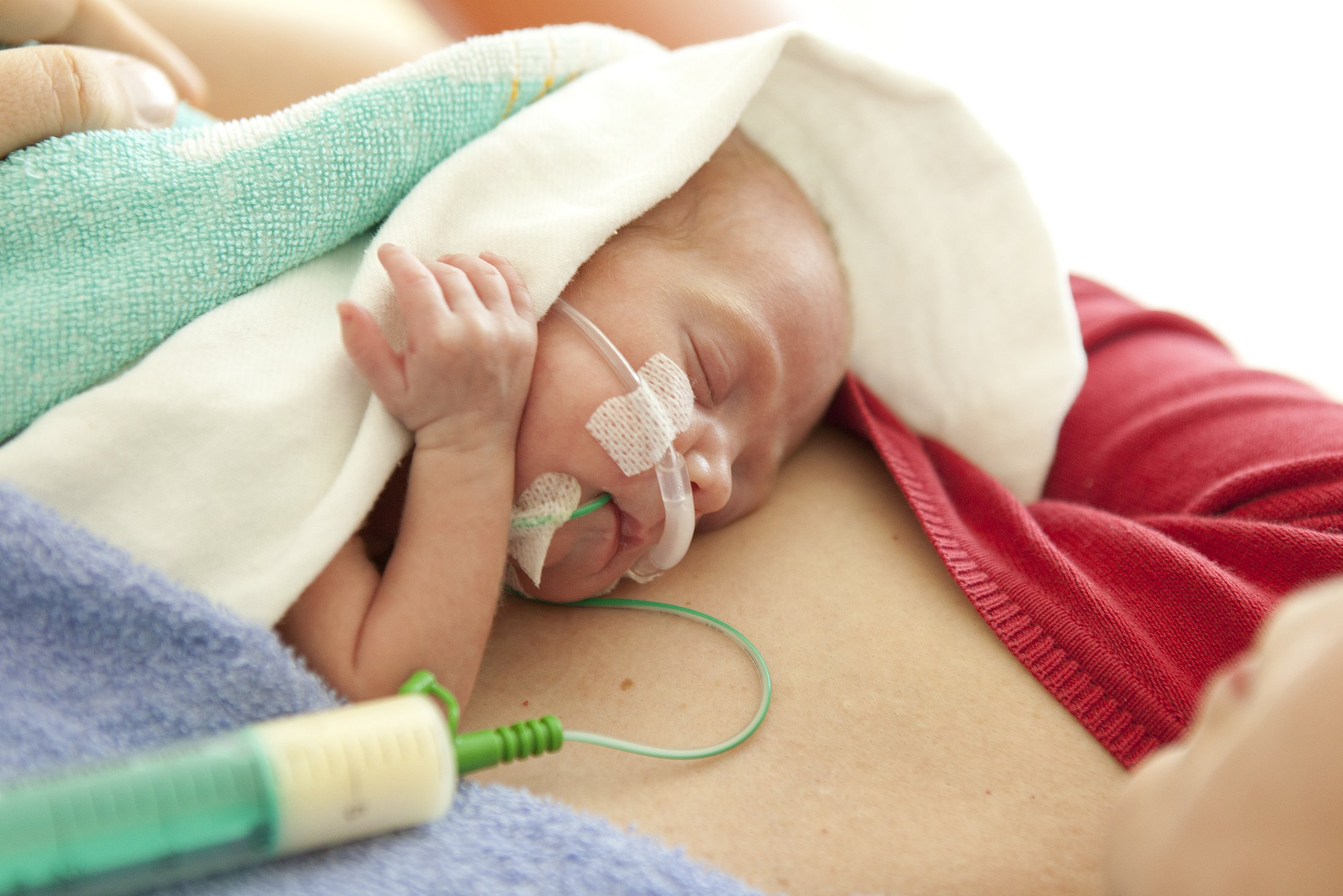 Preterm Infant Receiving Kangaroo Care Preterm infant with respiratory support resting on the mother’s chest during kangaroo care.