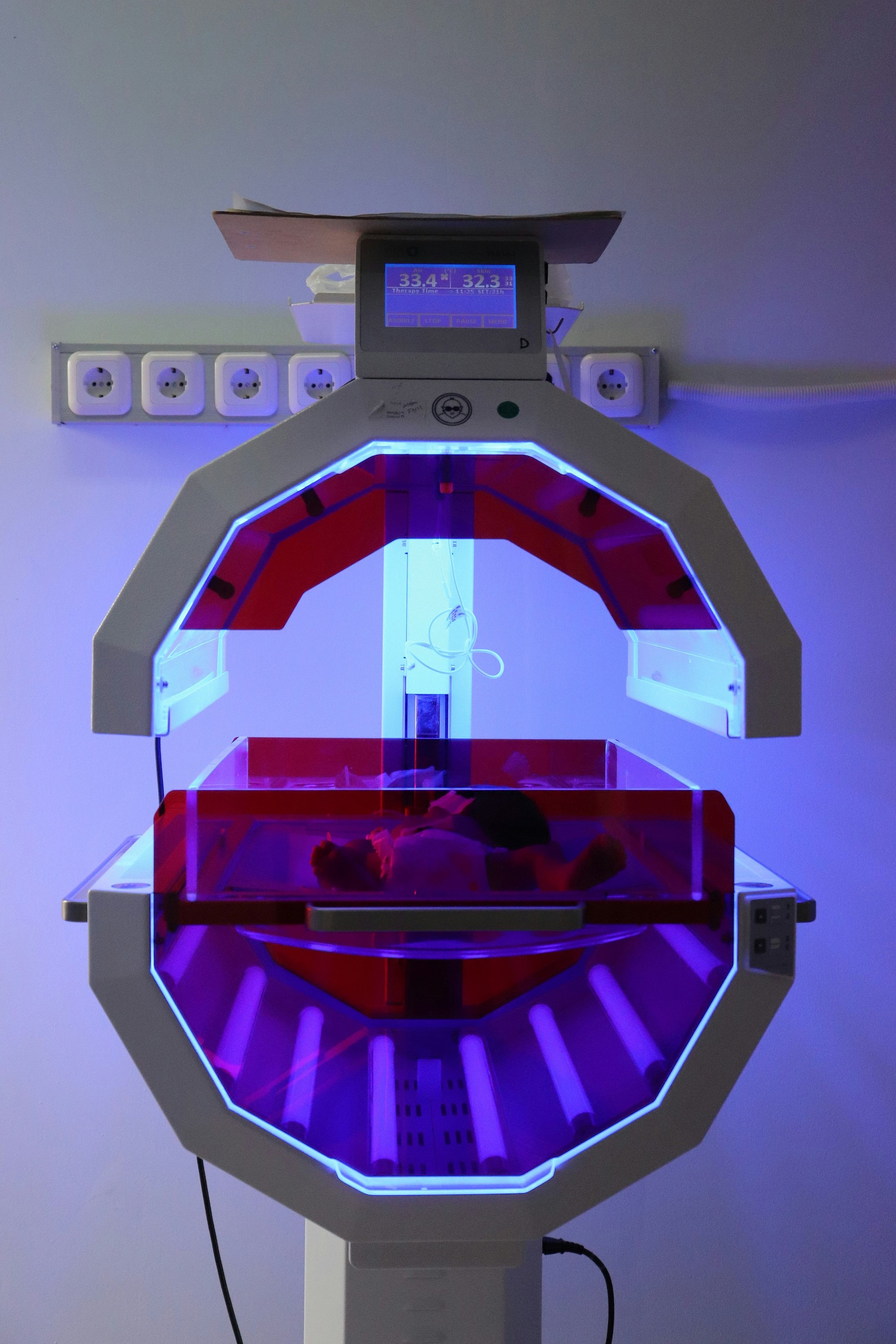 Phototherapy In Very Preterm Newborn Care Preterm newborn receiving phototherapy treatment under blue clinical lights in a neonatal care setting. The image illustrates phototherapy used for managing neonatal jaundice in very preterm infants.