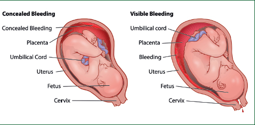 Concealed and visible bleeding during pregnancy and childbirth Medical illustration comparing concealed and visible obstetric bleeding around the placenta and uterus.