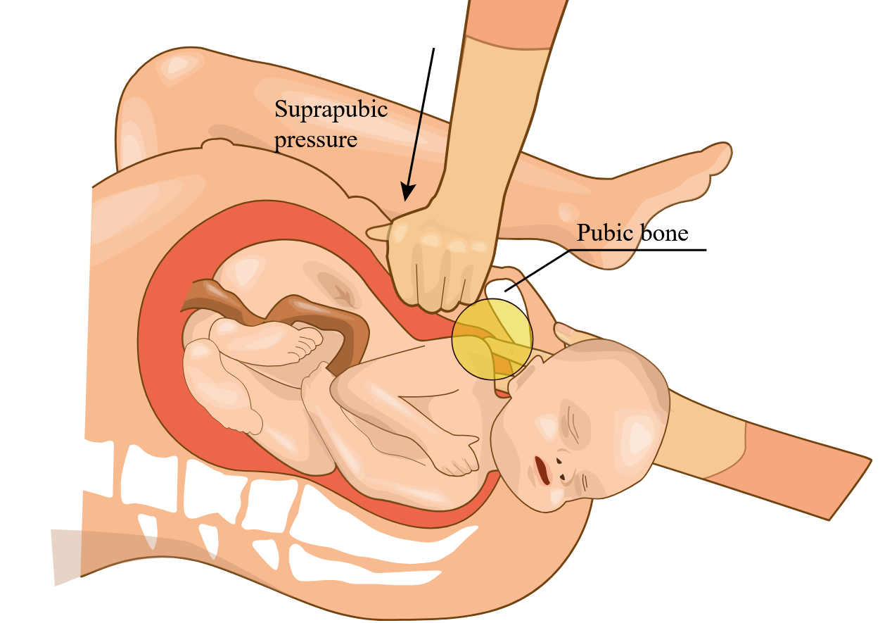Shoulder dystocia and suprapubic pressure during birth Medical illustration showing suprapubic pressure being applied during shoulder dystocia.