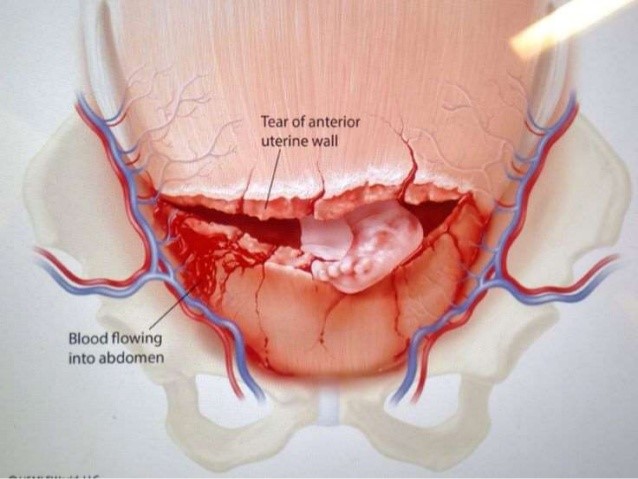 Uterine rupture during childbirth Medical illustration showing a tear in the uterine wall and bleeding into the abdomen.