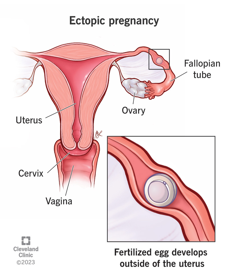 Ectopic pregnancy in the fallopian tube Medical illustration showing an ectopic pregnancy developing in a fallopian tube outside the uterus.