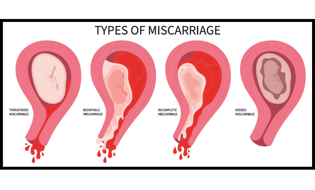 Medical illustration of different types of miscarriage Medical illustration comparing threatened, inevitable, incomplete, and missed miscarriage.
