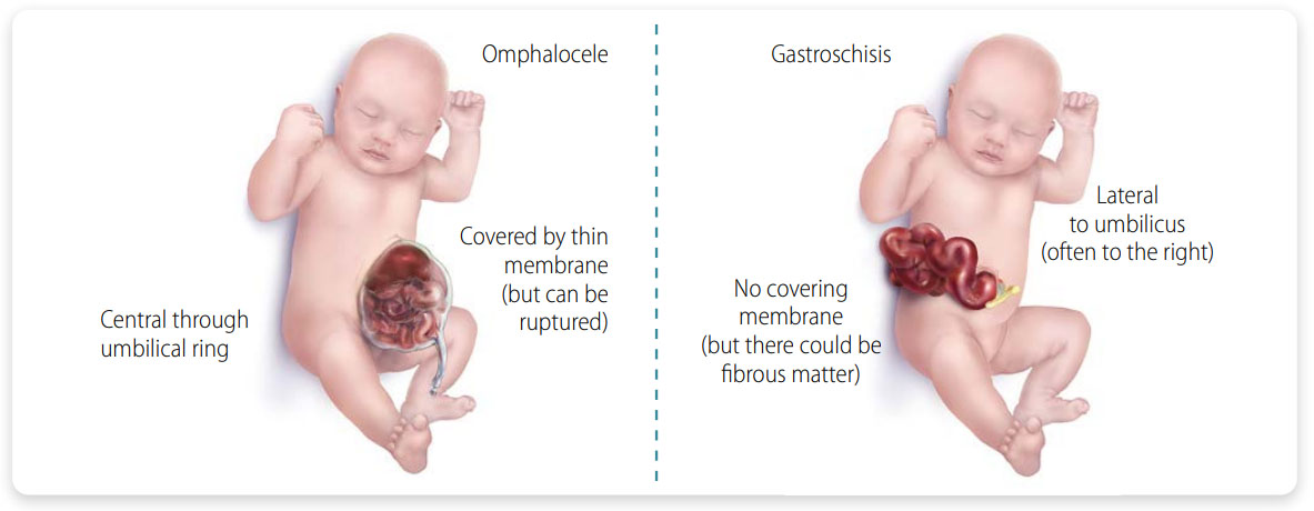 Omphalocele and Gastroschisis Medical illustration comparing omphalocele, in which organs protrude through the umbilical ring within a membrane, and gastroschisis, in which the bowel protrudes beside the umbilicus without a covering membrane.