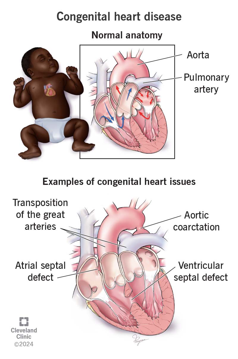 Congenital Heart Disease in Newborns Medical diagram comparing normal heart anatomy with congenital heart conditions including septal defects, transposition of the great arteries, and aortic coarctation.