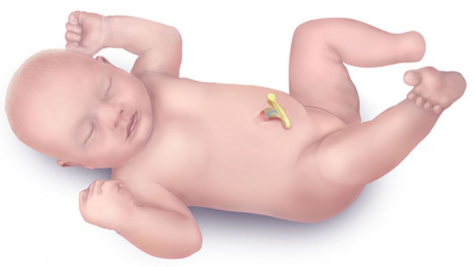 Congenital Limb Reduction Defect Medical illustration of an infant with a congenital limb reduction defect.