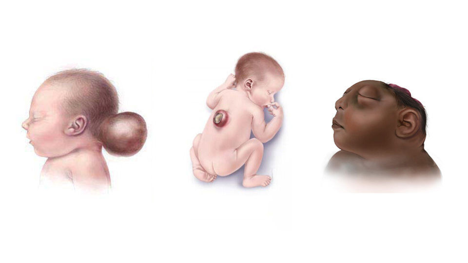 Neural Tube Defects in Newborns Three medical illustrations showing neural tube defects affecting the back of the skull, the spine, and the development of the brain and skull.