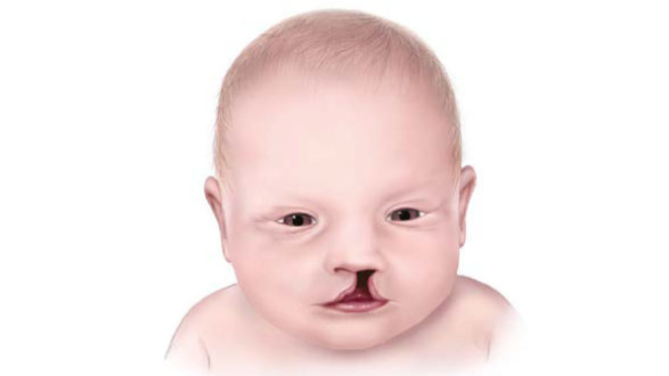Orofacial Cleft in a Newborn Medical illustration of an infant with a cleft affecting the upper lip.