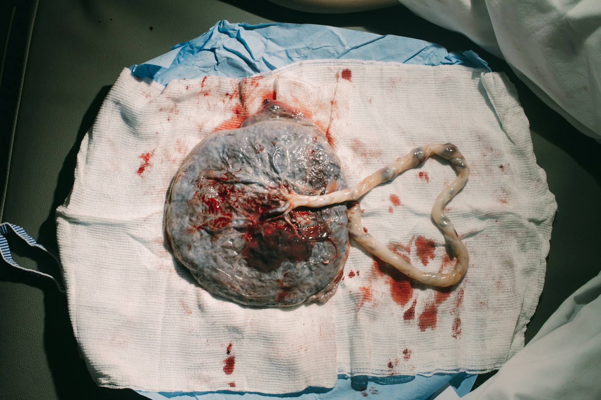 Placenta and Umbilical Cord Placenta with attached umbilical cord resting on medical gauze following birth.