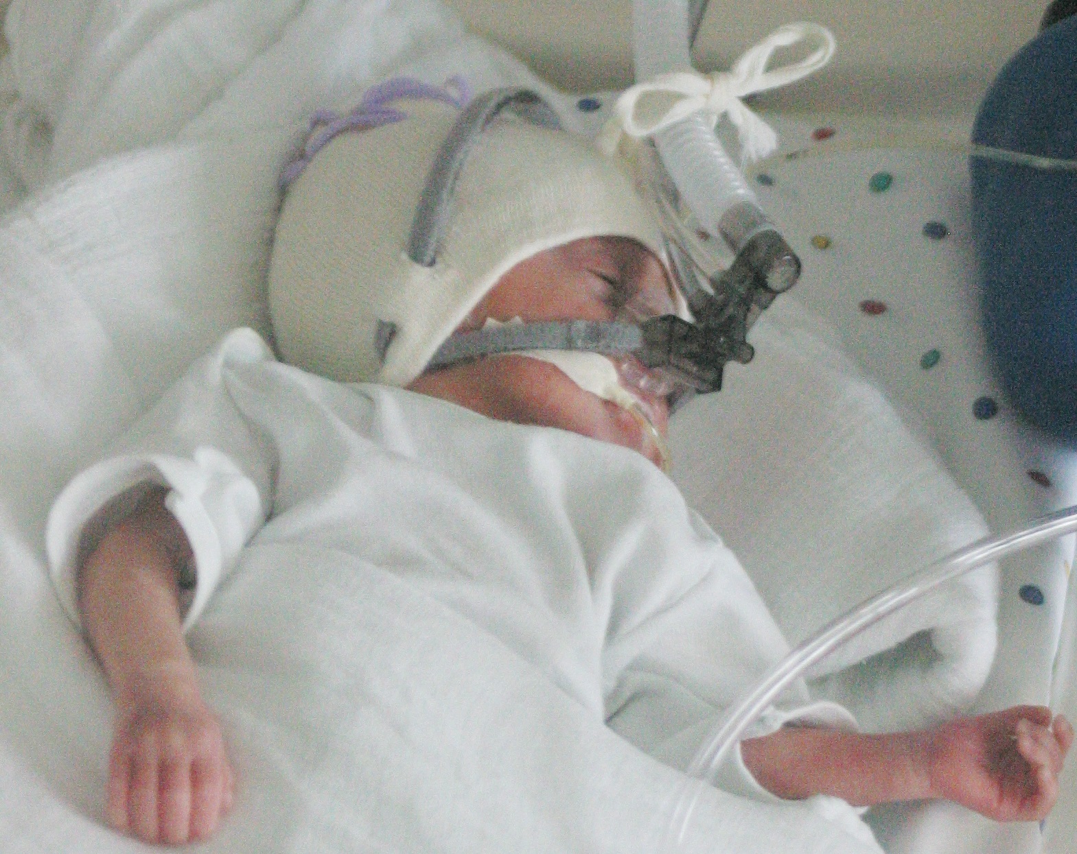 Preterm infant wearing respiratory support equipment and resting beneath a white blanket in a neonatal intensive care unit.