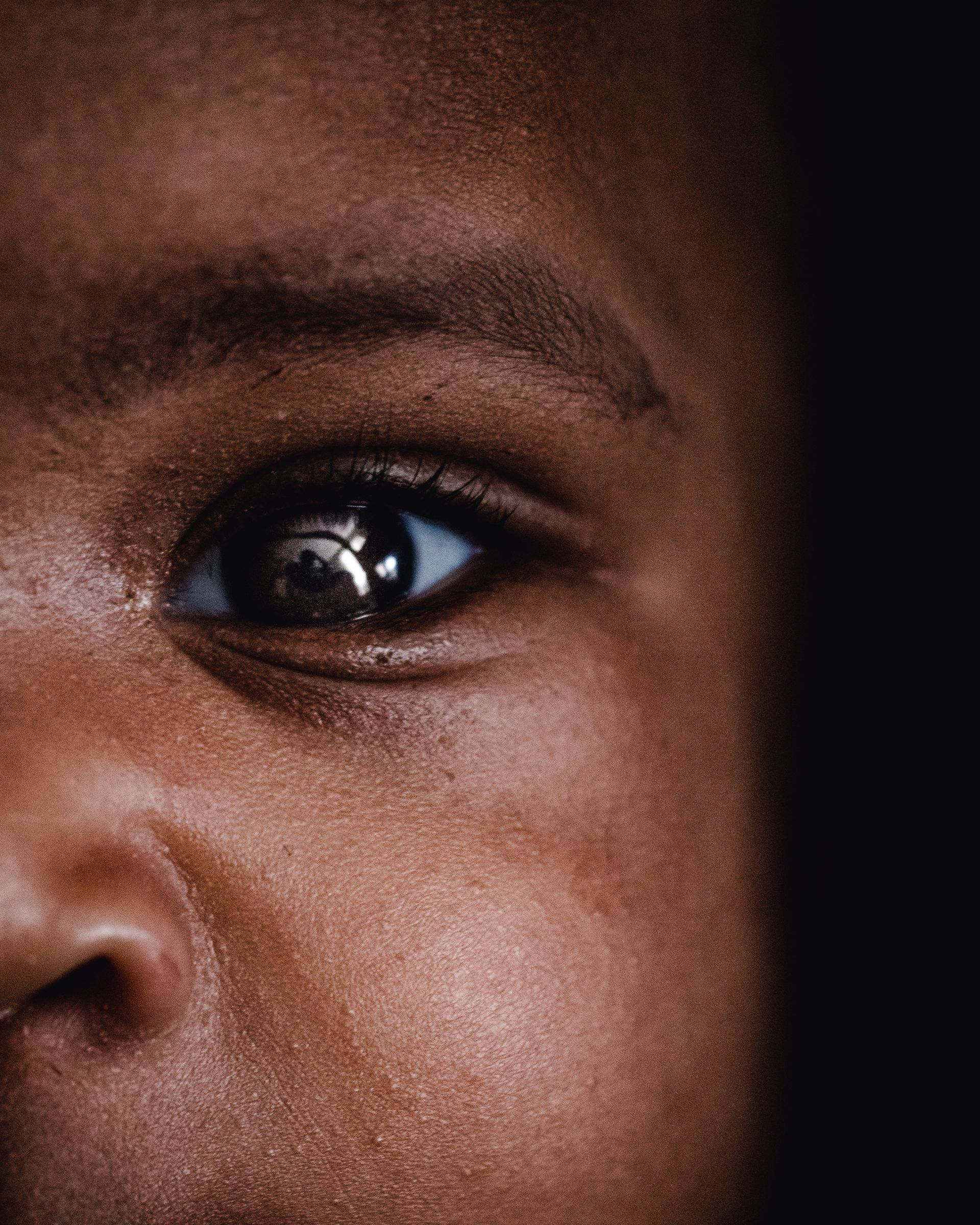 Eye Health and Vision After Preterm Birth Close-up of a baby’s eye and face against a dark background.