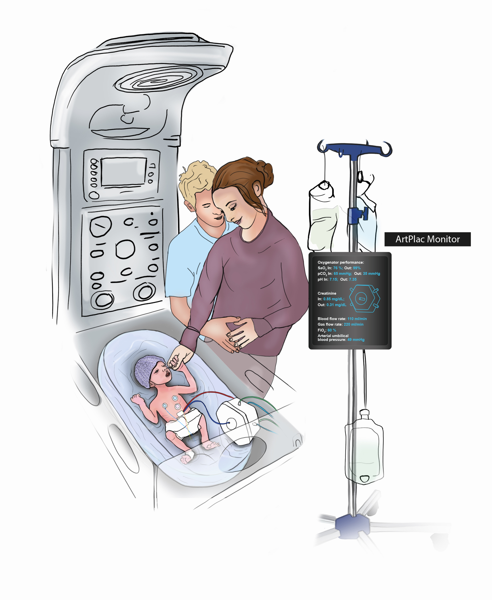Baby using ArtPlac system with mother holding hand, monitor showing vital signs and oxygenation.